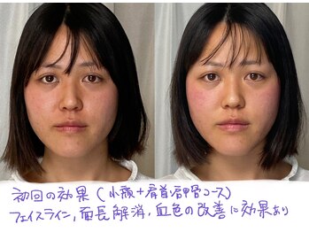 美容整体 アルマ/1回目の効果