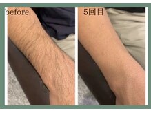 AG/【男性】腕まるごと脱毛