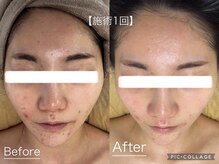 マスカレード 品川(Masquerade)/【ララピール症例写真】