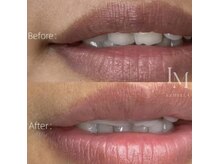 ミタス(Me+)/メラニンケア【ルメラ】唇