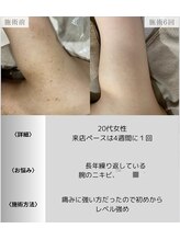 サロンエヌ 久留米店(Salon N)/二の腕のざらつき