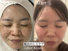 リベルキョウト 京都駅前店(Liber Kyoto)/魔法のシミケア