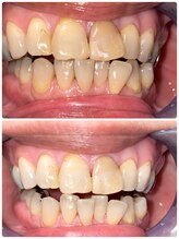 コントレール 歯ぁと(CONTRAIL)/ビフォーアフター