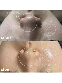 スピカ(Spica)/毛穴悩みもこの通り♪