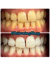 ホワイトニングショップ 吉祥寺2号店/今まで落ちなかった着色汚れ