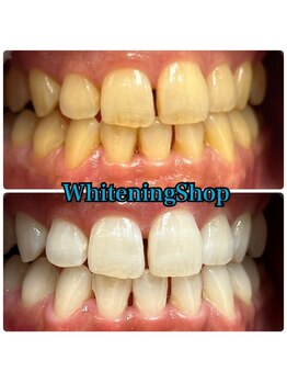 ホワイトニングショップ 吉祥寺2号店/今まで落ちなかった着色汚れ