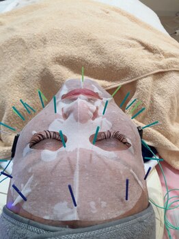 瑞 鍼灸院/幹細胞美容鍼