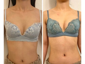 美人バスト 南森町店/バストアップ ◇症例◇