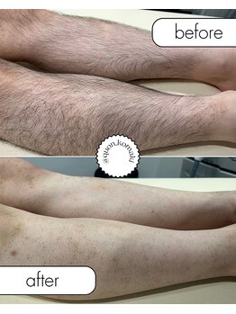 久遠(クオン)/メンズ 脚脱毛 2025/5/20