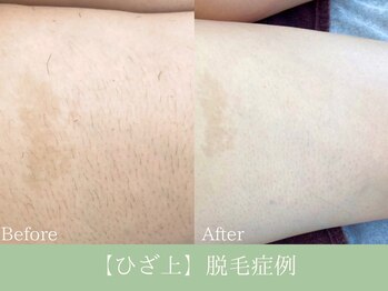 エピア 岡崎店(Epia)/ひざ上脱毛　10回の変化