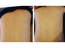 ベビースキン(baby skin)/背中のフォトボディ