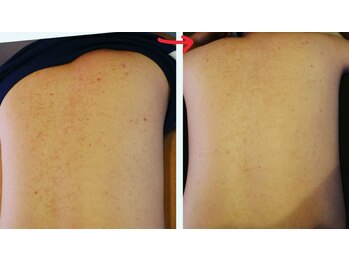 ベビースキン(baby skin)/背中のフォトボディ