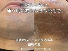 ダイヤ 名古屋中川区店(Daiya)/メンズ脱毛/ヒゲ【BeforeAfter】