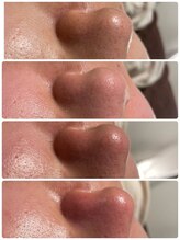 ユフラ(Juhla)/韓国3D毛穴洗浄