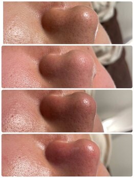 ユフラ(Juhla)/韓国3D毛穴洗浄