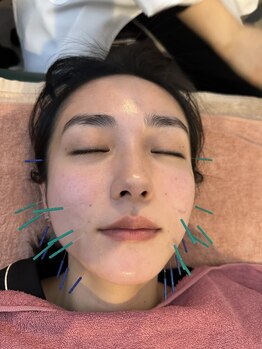 ナノフェイス 名古屋駅前店(nano face)の写真/《名古屋駅徒歩1分》凝り固まった肩こり・肩甲骨&フェイスラインのもたつきに★小顔美容鍼×小顔矯正¥3980