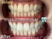 札幌セルフホワイトニング ラディアンス(Radiance)/初回15分3回照射