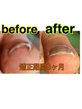 巻き爪ケアセンター 横須賀/巻き爪before⇒after