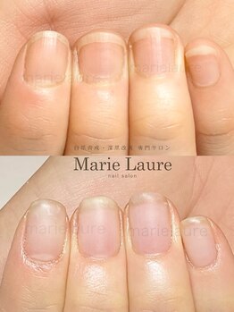 マリーロール 梅田店(Marie Laure)/自爪育成/深爪矯正/ネイルケア