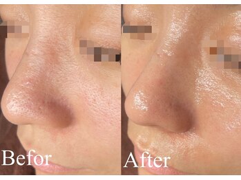 レア 姫路店(le'a)/艶肌×毛穴改善