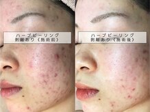 育肌美研 自由が丘サロン/ニキビケア｜ハーブピーリング