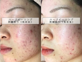 育肌美研 自由が丘サロン/ニキビケア|ハーブピーリング