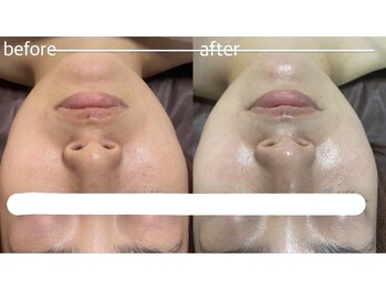 ライチャス(RAICHAS)/陶肌トリートメント4回