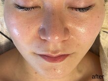 サロン ド エメ(salon de aimer)/【After】赤み鎮静 毛穴縮小