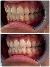 ユーラボ 表参道(YOU-LAB)/Befor/After【ホワイトニング】