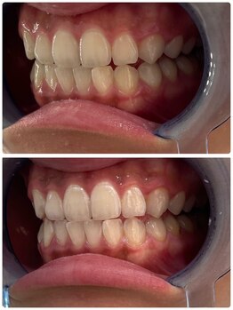 ユーラボ 表参道(YOU-LAB)/Befor/After【ホワイトニング】