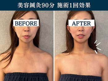 シンク 表参道(CINQ)/美容鍼灸90分はリピート率No.１