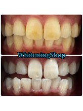 ホワイトニングショップ 吉祥寺2号店/ 短期間で最大限に白く