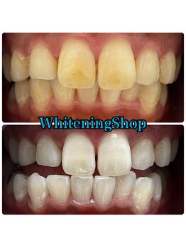 ホワイトニングショップ 吉祥寺2号店/ 短期間で最大限に白く