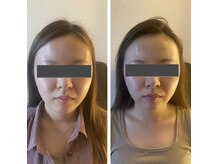 リノリー(rinory)/小顔コルギ