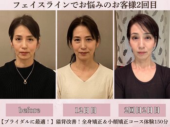 フラン(franc)/リフトアップ＆若々しさアップ