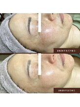 ネリネ(Nerine)/光フェイシャル