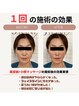 クローバー鍼灸整骨院/美容鍼+小顔矯正マッサージ
