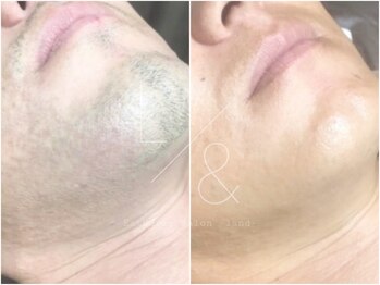 ランド 中目黒(L&)/ヒゲ脱毛(20回照射)