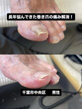 巻き爪じゅん 千葉駅前店/長年の巻き爪と痛みが改善！