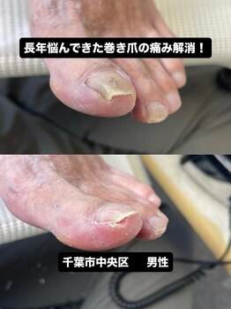 巻き爪じゅん 千葉駅前店/長年の巻き爪と痛みが改善！