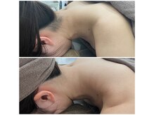 ミース 福岡本店/うなじ矯正◆ビフォーアフター