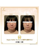 ランベリー 新宿店(Lembellir)/超最新！ハイパーナイフ EX2導入