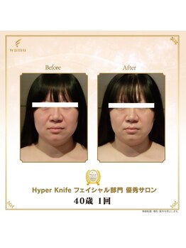 ランベリー 新宿店(Lembellir)/超最新！ハイパーナイフ EX2導入