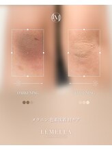 エルビービュティーサロン(LB BEAUTY SALON)/【ルメラ乳輪】実績数関西1★