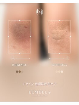 エルビービュティーサロン(LB BEAUTY SALON)/【ルメラ乳輪】実績数関西1★