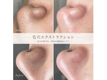 エミュ(emu)の雰囲気（毛穴の黒ずみ・角栓詰まりを一つ一つ丁寧に取り除く本格毛穴ケア）