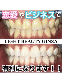 ライトビューティー 銀座店(LightBeauty)/東銀座 ホワイトニング症例写真