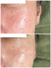 ビジュープラス 幸手店(Bijou+)/シワ・毛穴ケア