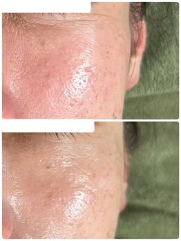 ビジュープラス 幸手店(Bijou+)/シワ・毛穴ケア