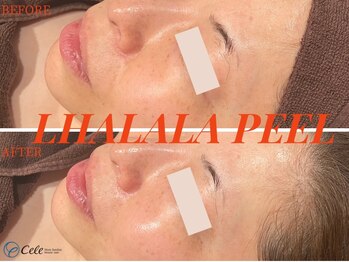 セレ(Cele)/ララピール